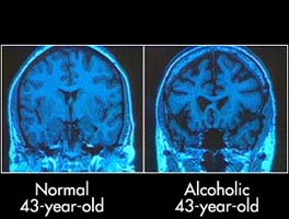 AlcBrainComparison