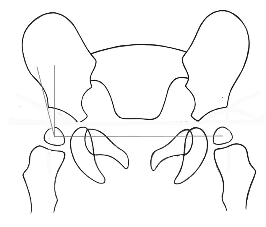 DRAD Pediatric Normal Measurements AP Pelvis Radiograph Center Edge Angle