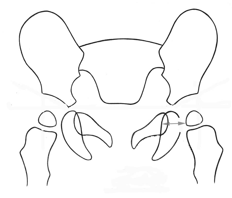 DRAD Pediatric Normal Measurements AP Pelvis Radiograph Medial Joint Space