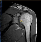 MSK MR Adult Shoulder