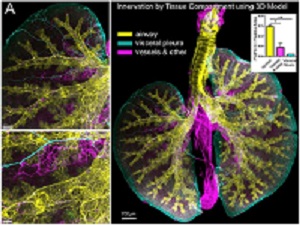 Image showing a lung with asthma