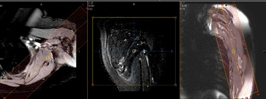 MR Scapula Image-Coronal Slice Position
