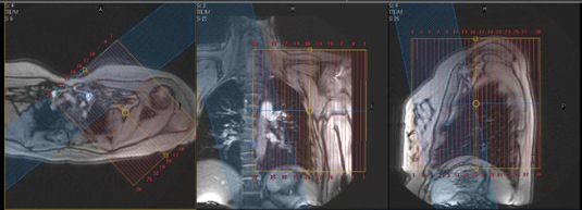 MR Scapula Image-Sag Slice Position