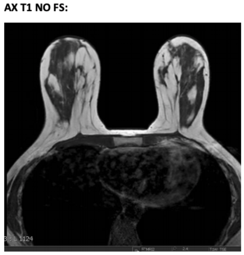MR Breast AX T1