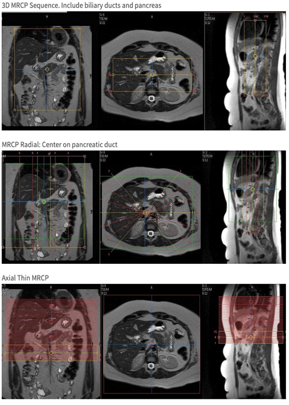 MR Adult Liver Mass with MRCP WO BODY Protocol image