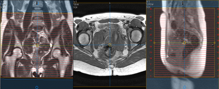  MR Defecography WO BODY Protocol image 1