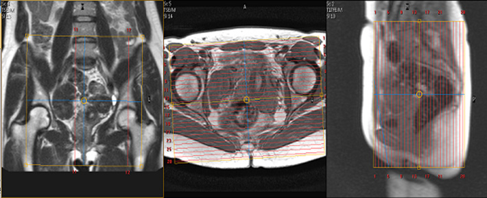  MR Defecography WO BODY Protocol image 2