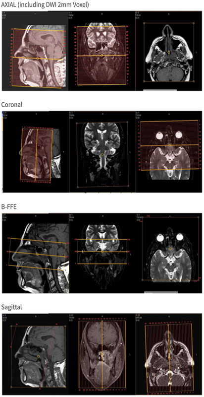 MR Parotid, Face, Sinus or Skull Base WO ENT Protocol image