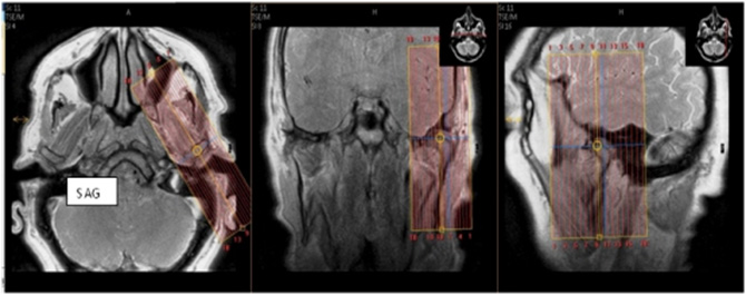 MR TMJ WO ENT Protocol image 2