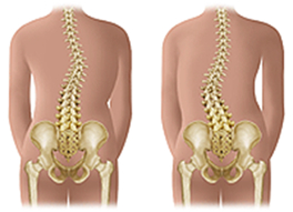 An illustration shows two common scoliosis curves. It depicts a child with an S-shape curve and one with a C-shape curve.