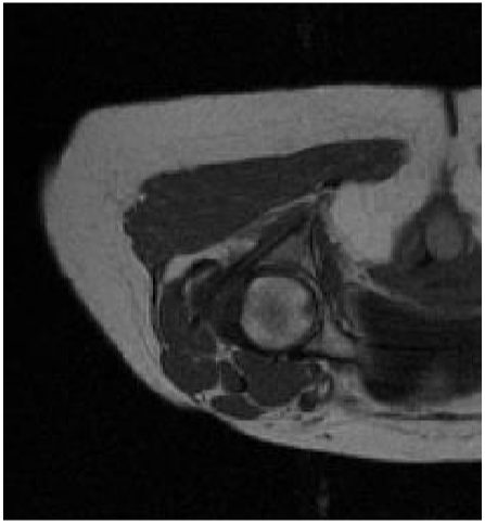 MR MATERIALISE LOW-RES AXIAL HIP