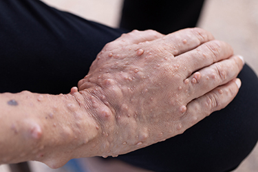 Tumors called neurofibromas are a symptom of neurofibromatosis 1.