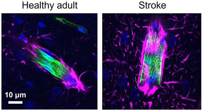 Side-by-side images contrasting  brain sections of the healthy rat and the post-stroke rat.