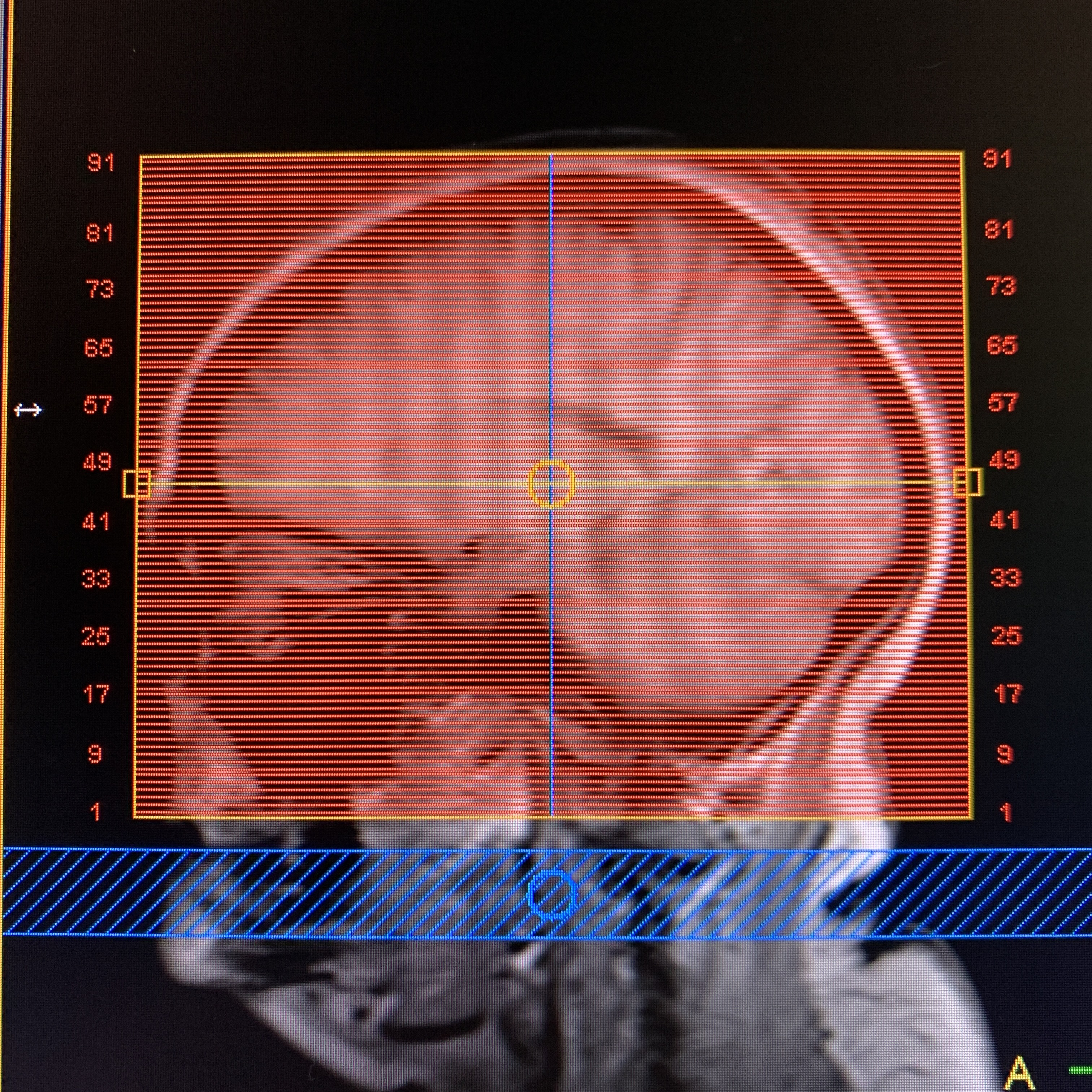 MRV Axial Planning for MRI technologists