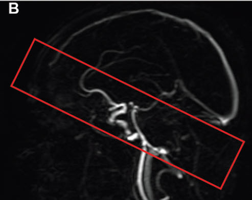 graphic showing coverage for vessel wall imaging 