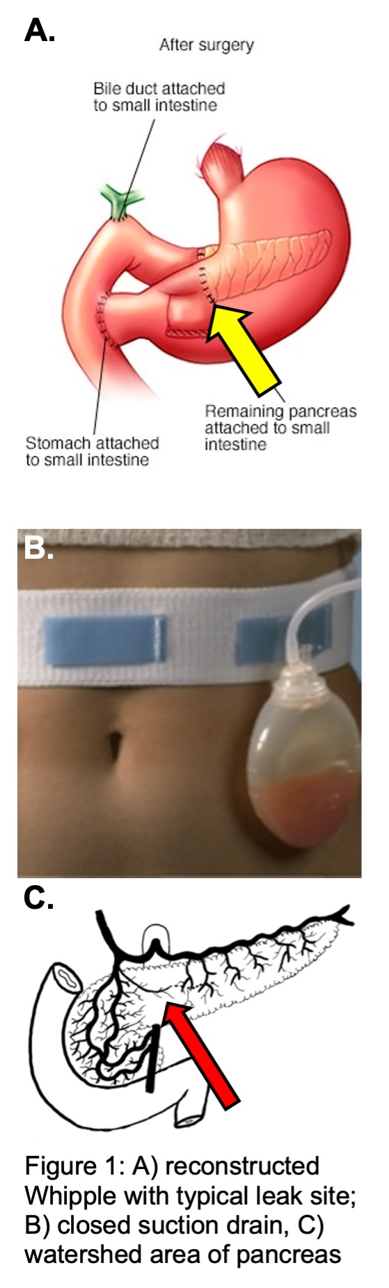 This image illustrates the reconstruction of the digestive tract after removal of the pancreatic head and illustrates the pancreatic anastomosis which can leak after surgery.  A surgical drain demonstrating a pancreatic leak is depicted as is the blood supply to the pancreas which has a watershed zone that is poorly perfused and may contribute to postoperative pancreatic leaks. 