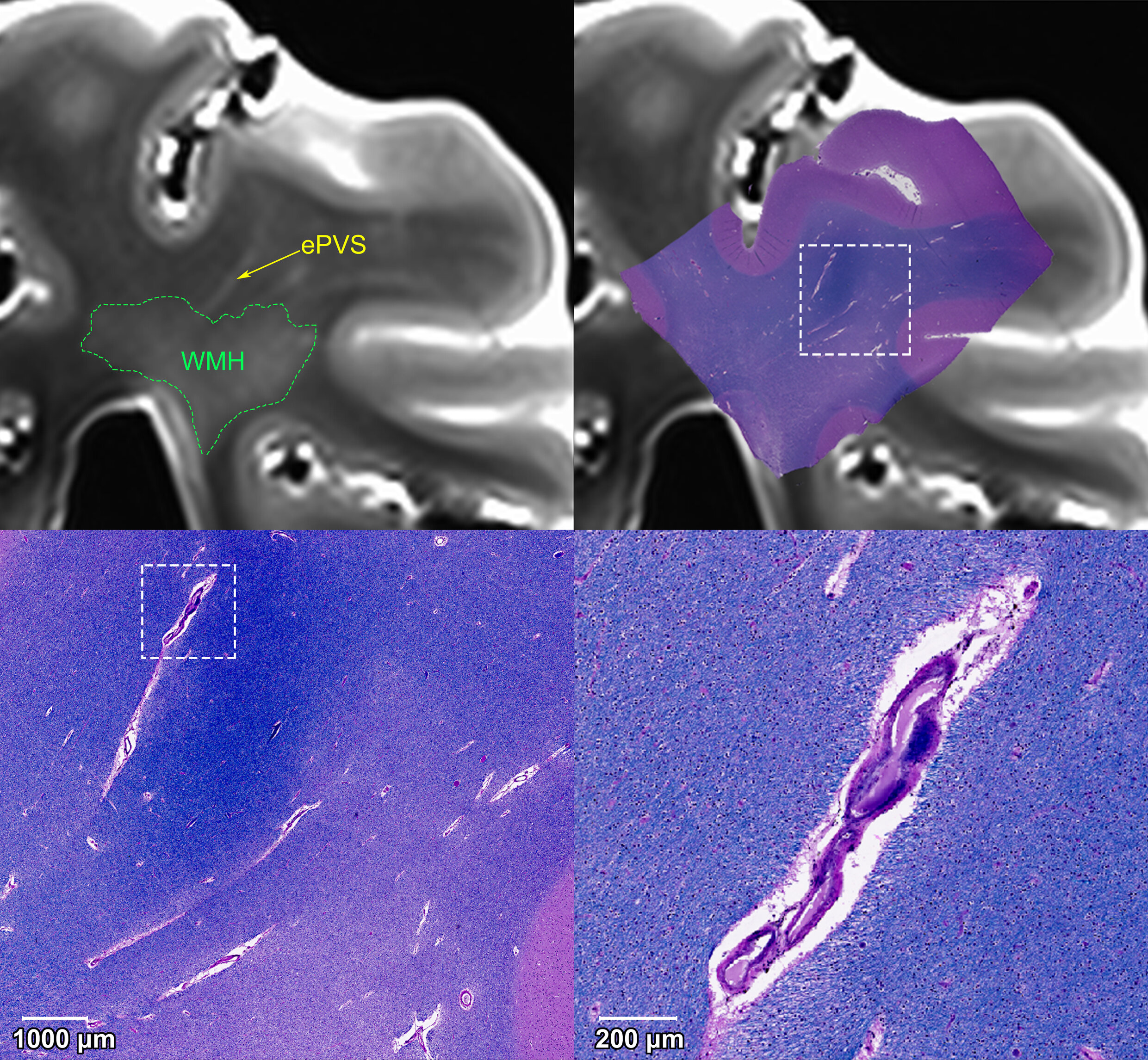 White matter hyperintensities and enlarged perivascular spaces identified in postmortem MRI scan of the brain