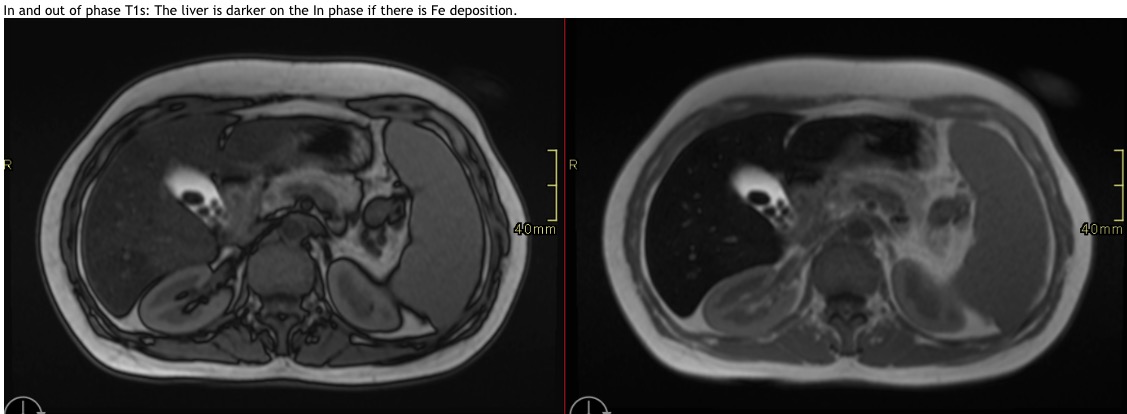 In and out of phase T1s: The liver is darker on the In phase if there is Fe deposition.