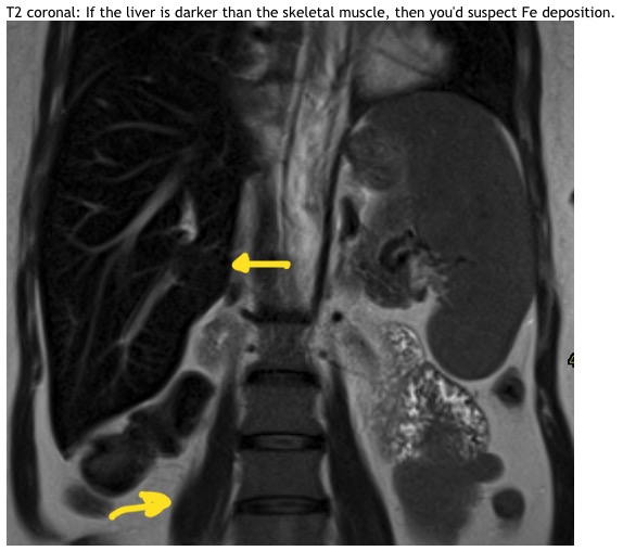 FE Quant information for MRI techs