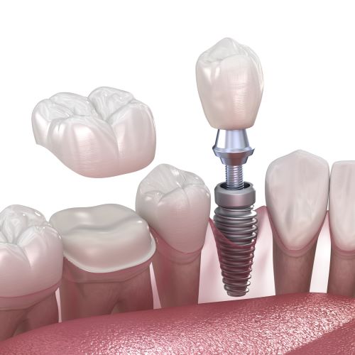 Graphic drawing of a partial row of lower teeth with an exposed metal implant showing its parts. Another tooth is showing a cap mid-air to be placed on the tooth below it.