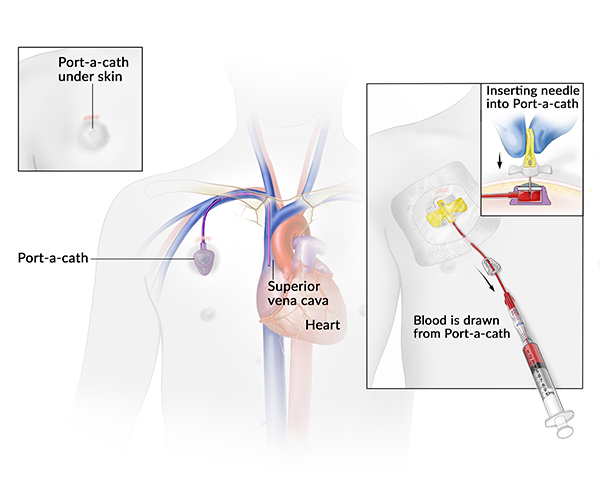 Port-a-cath: A set of four illustrations. One illustration shows the port-a-cath implanted under skin. A second illustration shows a port-a-cath implanted in the chest, with an attached tube running through the superior vena cava, a vein that leads to the heart.  A third illustration shows a needle being inserted into the port-a-cath. A fourth illustration shows a syringe drawing blood from the port-a-cath.