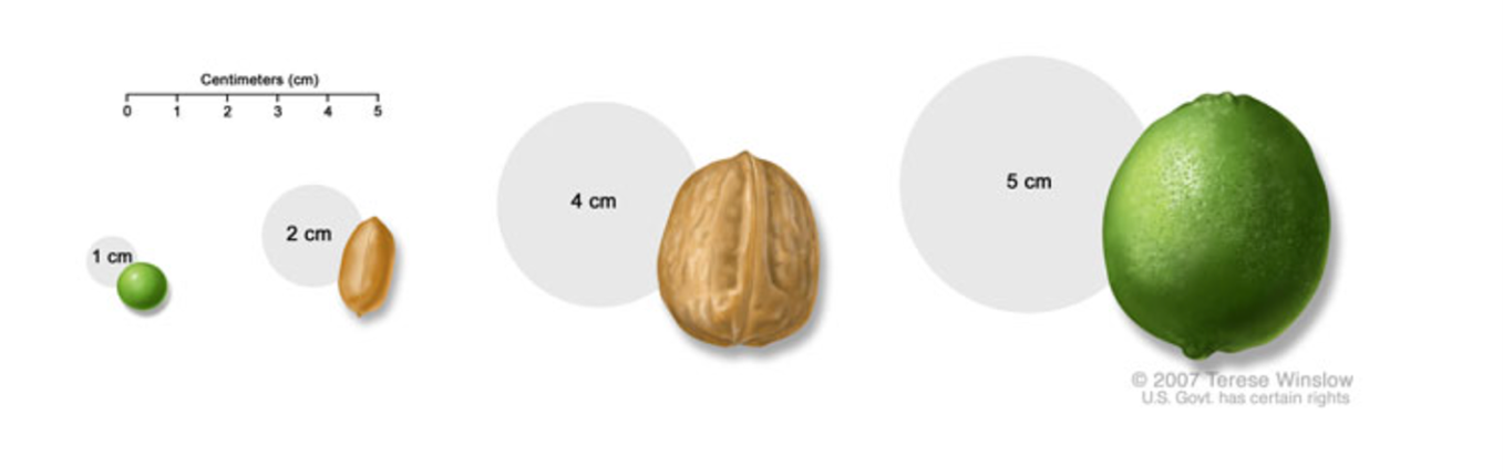 A drawing shows a pea to show the rough size of a 1 centimeter tumor; a peanut to show the rough size of a 2 centimeter tumor; a walnut to show the rough size of a 4 centimeter tumor; and a lime to show the rough size of a 5 centimeter tumor.