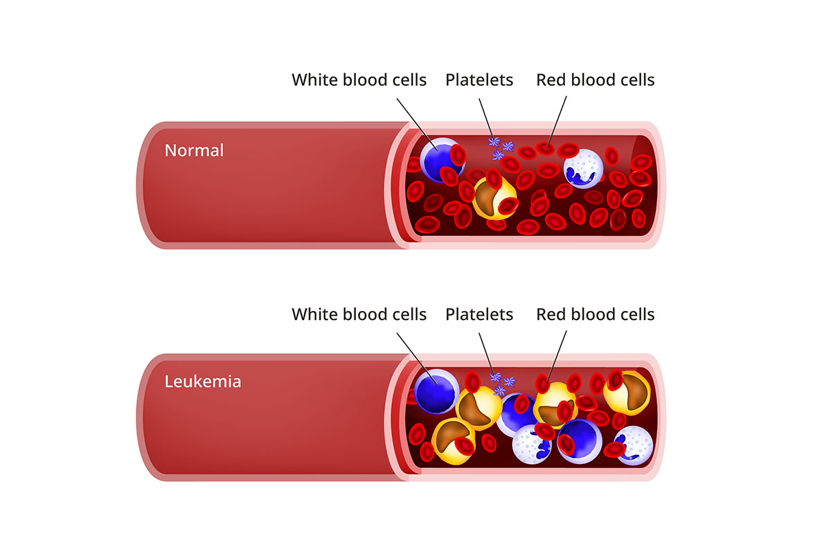 A diagram showing the bloodstream of a healthy child, and the bloodstream of a child with leukemia.