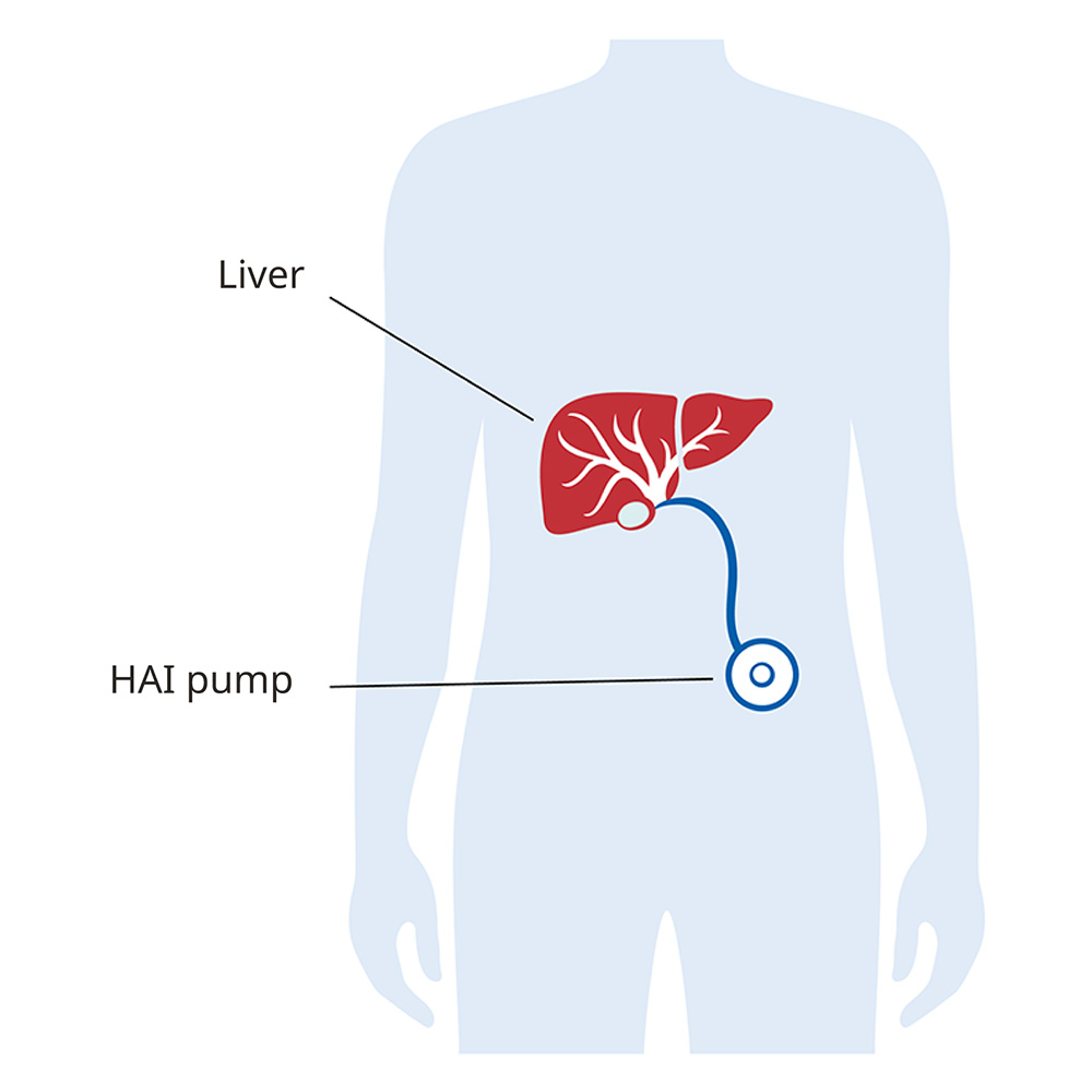 This simple illustration depicts a human torso with the liver highlighted in red. A small pump, about the size and shape of a hockey puck, sits inside the abdomen. The pump is connected to the liver by a thin tube.
