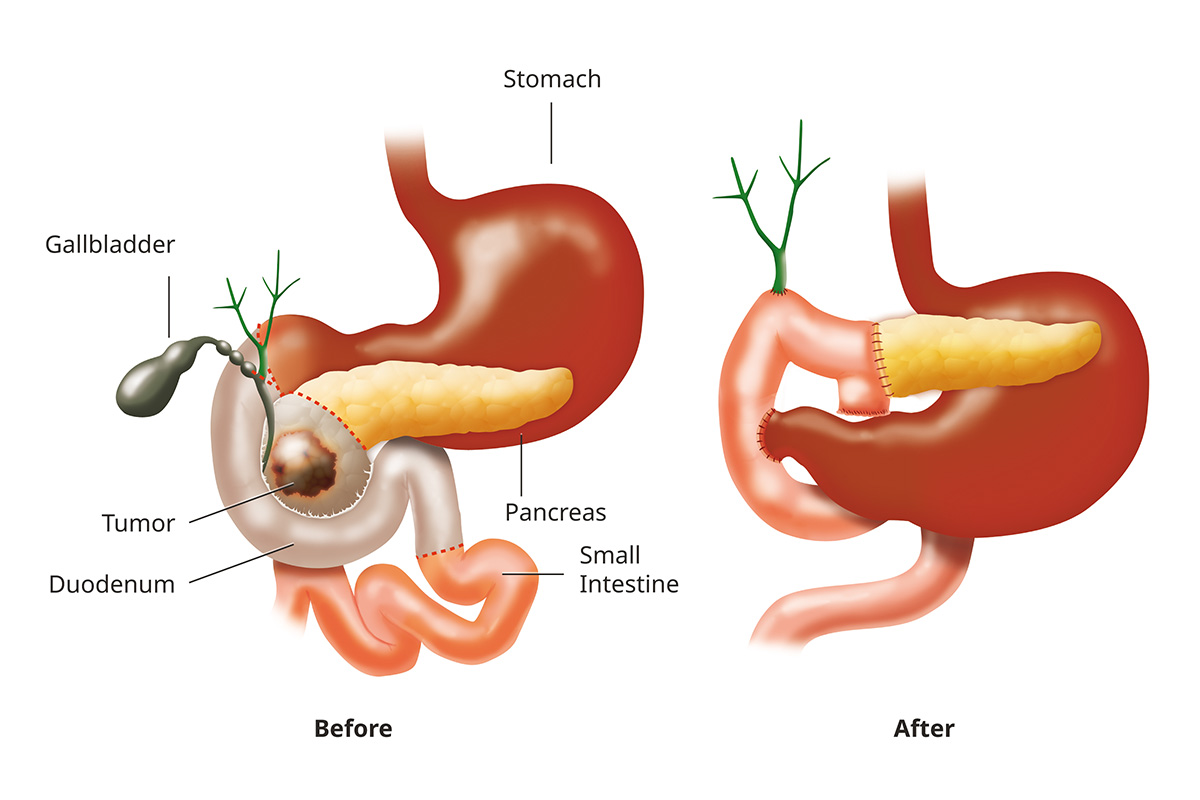 A drawing shows part of the digestive system before and after the Whipple procedure. The “after” drawing shows that surgery removed the tumor, part of the pancreas, the top part of the small intestine, the gallbladder and parts of the stomach. The small intestine is reconnected to the stomach.