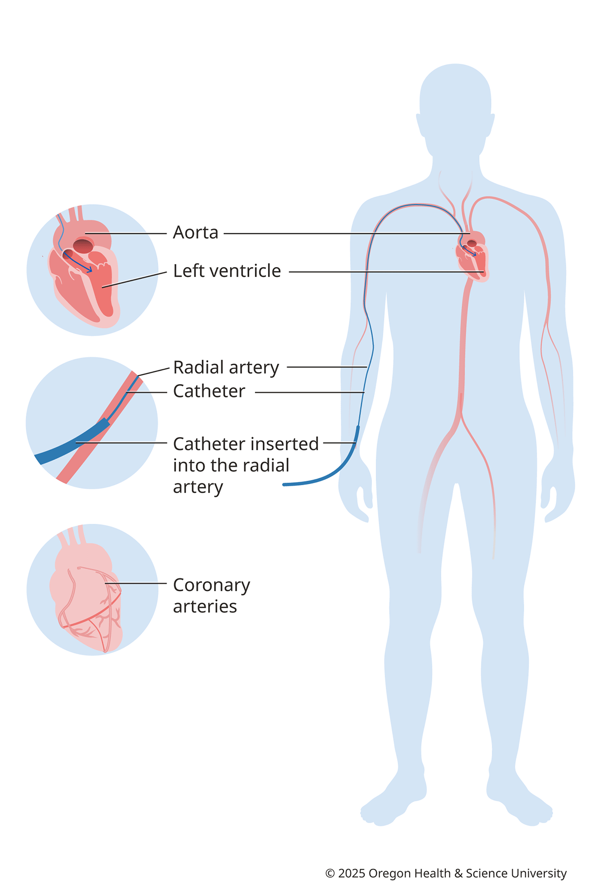 Diagram of the heart catheterization process with zoomed in images of the aorta, radial artery with catheter and coronary arteries. Our doctores are experts in minimally invasive heart catheterization. We use a thin flexible tube (catheter) and tiny tools to diagnose and sometimes treat heart conditions.