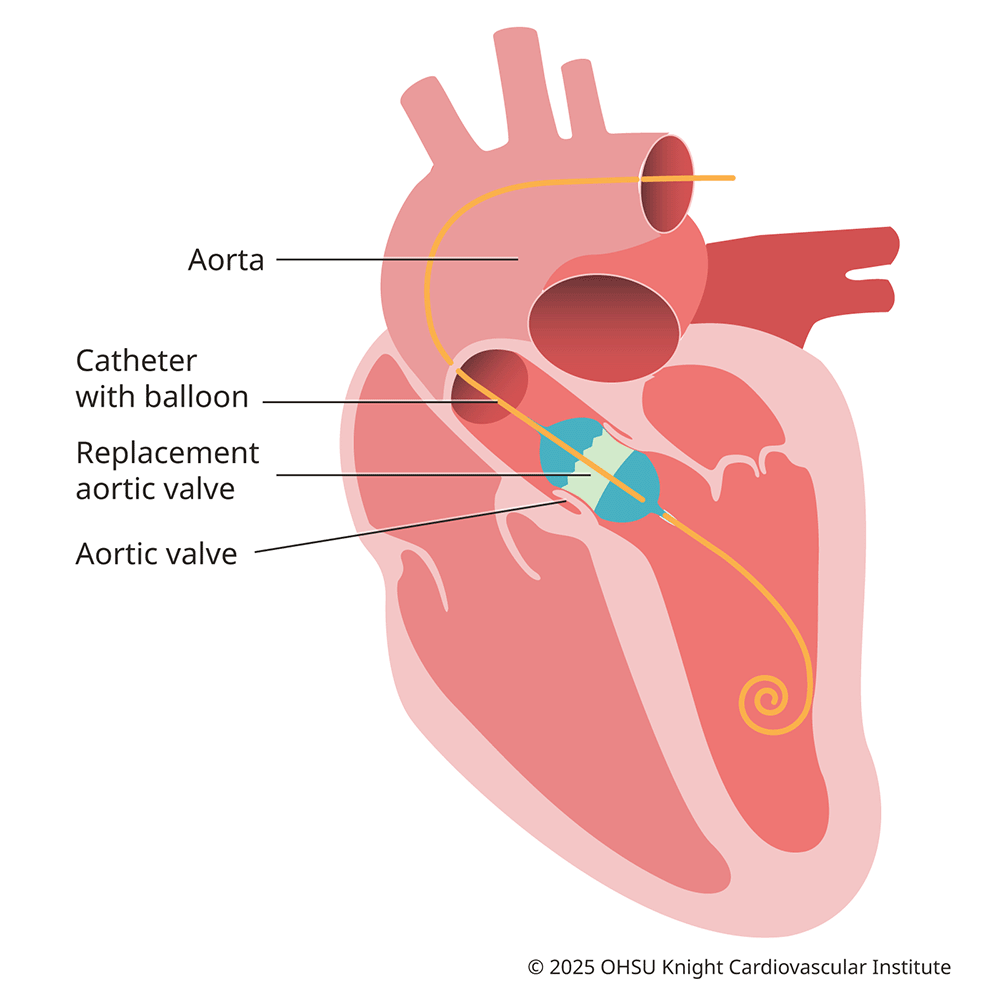 Medical illustration of Transcatheter aortic valve replacement. Our team is the only Oregon hospital that can repair or replace all four of the valves of the heart using a catheter. We are national leaders in these minimally invasive procedures.