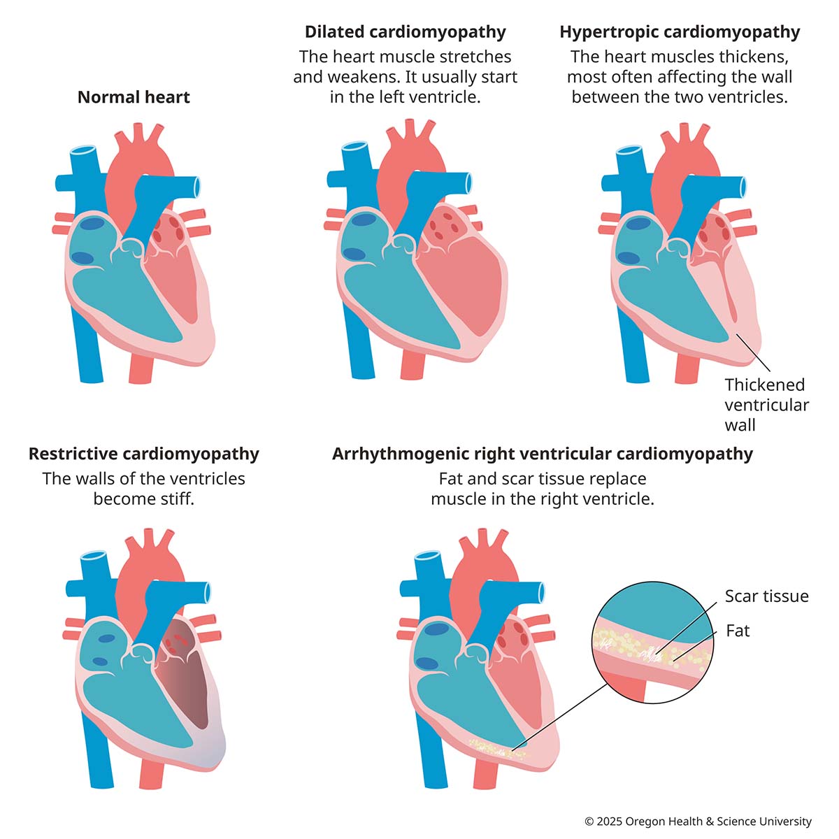 A diagram of different types of cardiomyopathy, compared to a normal heart.