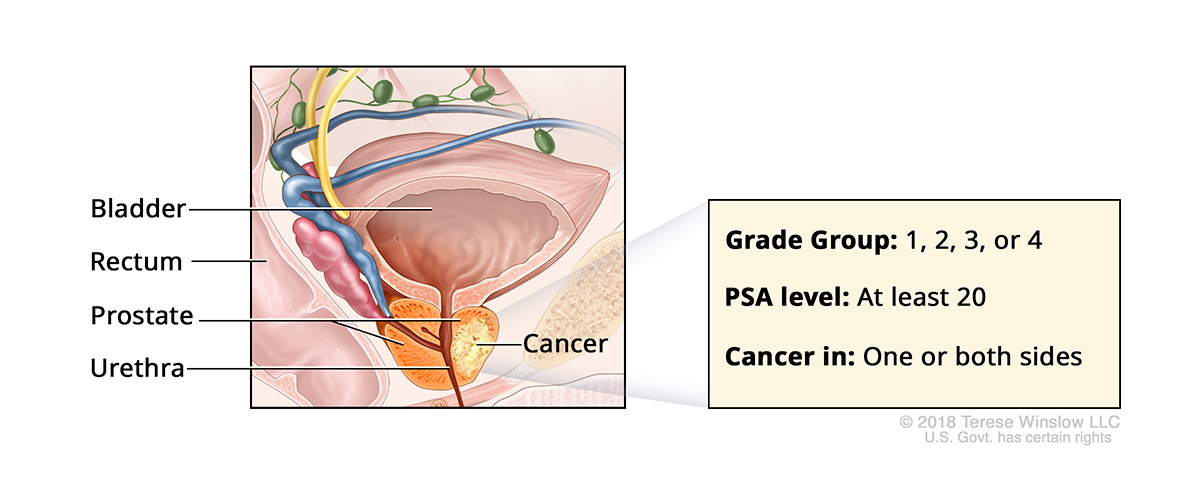 A drawing shows cancer in the prostate gland and labels the prostate, bladder, rectum and urethra.