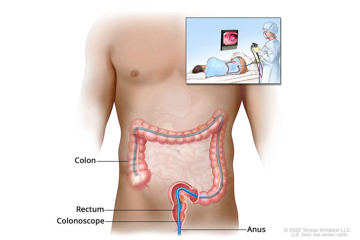 An illustration shows how a doctor guides a thin tube through the anus to inspect the rectum and colon. The sedated patient lies on their side. The colon makes an upside-down U shape. The tube travels vertically up the colon, horizontally as the colon travels across the upper belly, and down the lower belly.