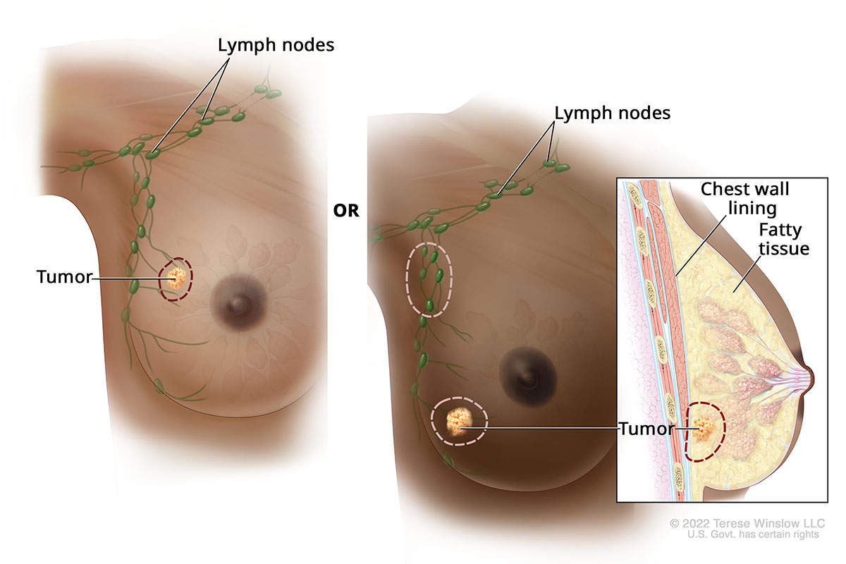 An illustration shows how a lumpectomy may remove a breast tumor and nearby lymph nodes.