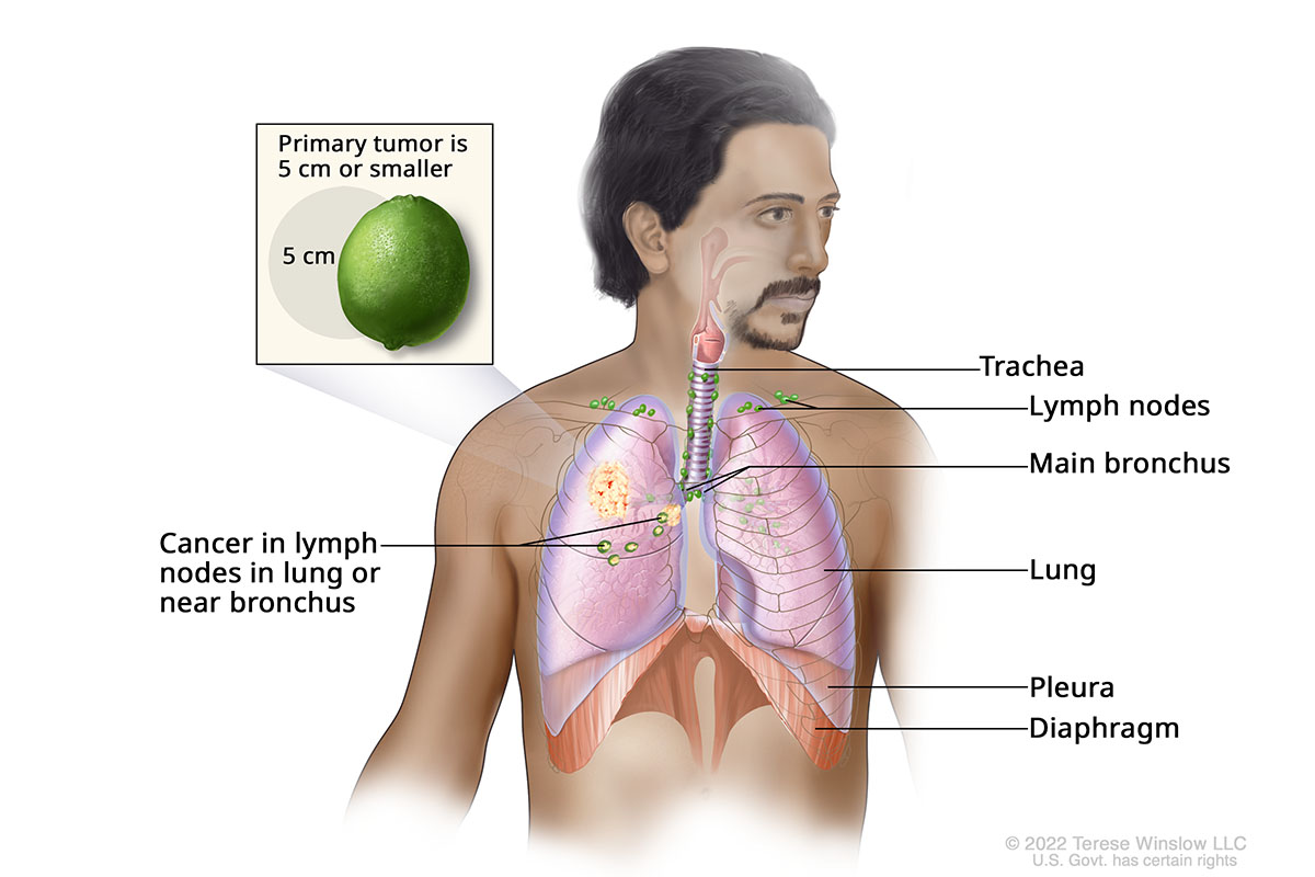 A drawing shows a tumor in a person's lung and cancer in lymph nodes. A detail drawing compares the tumor size to a lime labeled 5 centimeters.