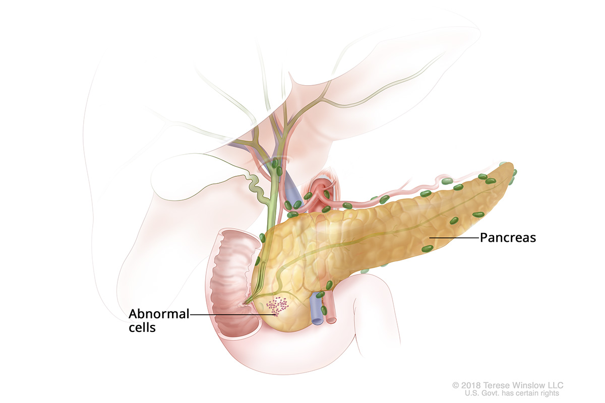 A drawing of stage 0 pancreatic cancer shows abnormal cells in the pancreas.
