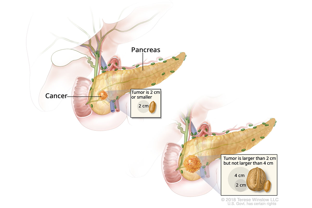 A drawing of stage 1A pancreatic cancer shows a 2-centimeter tumor in the pancreas. An inset shows that 2 centimeters is about the size of a peanut. A drawing of stage 1B pancreatic cancer shows a tumor between 2 and 4 centimeters in the pancreas. An inset shows that 2 centimeters is about the size of a peanut and 4 centimeters is about the size of a walnut.