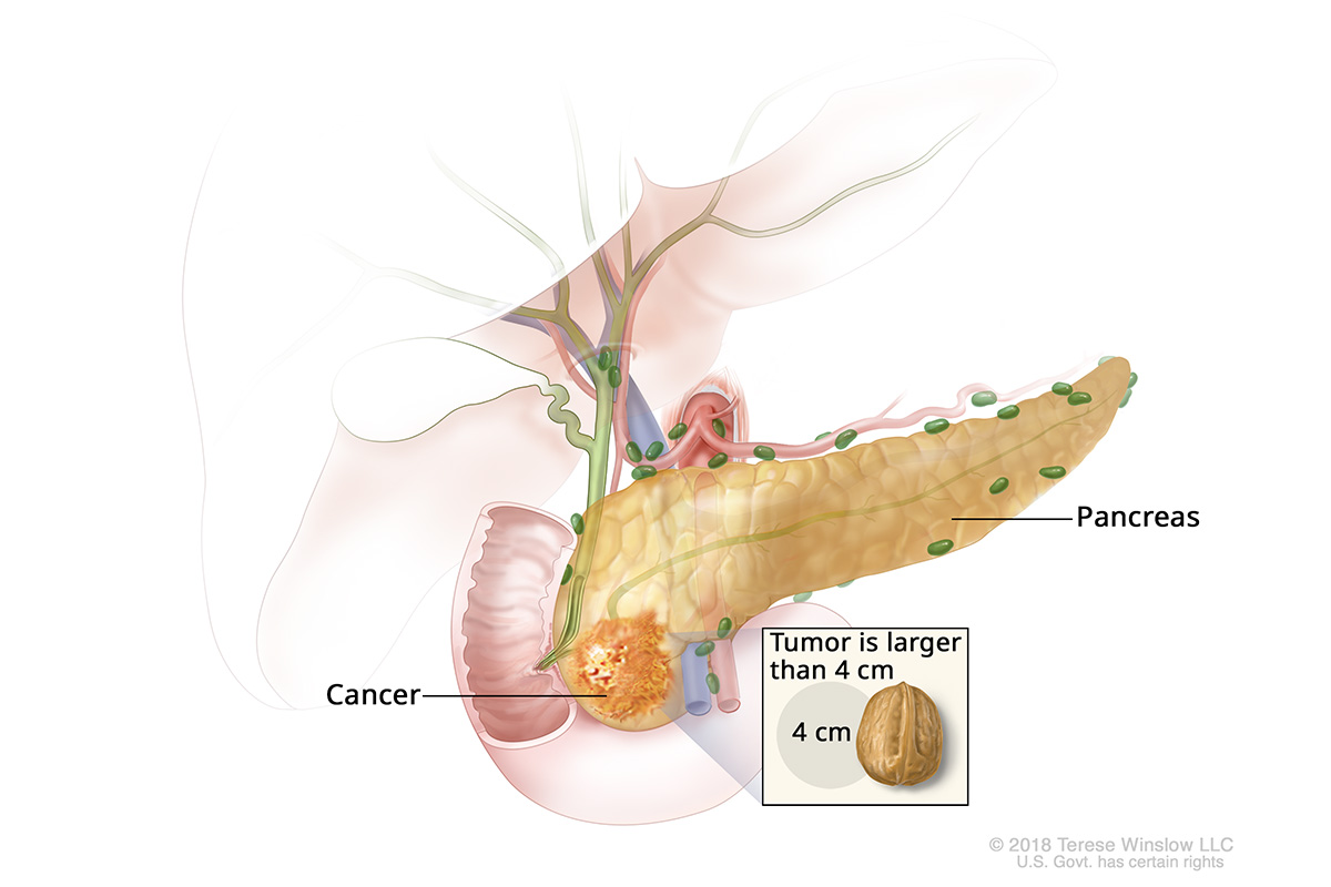 A drawing shows a tumor larger than 4 centimeters in the pancreas. An inset shows 4 centimeters is about the size of a walnut.
