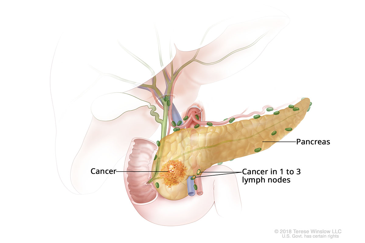 A drawing shows cancer in the pancreas and one to three nearby lymph nodes.