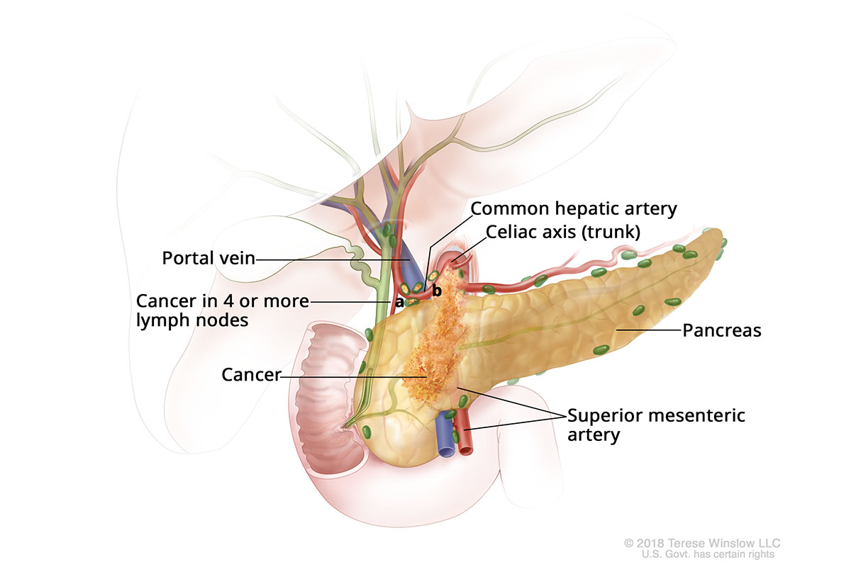 A drawing shows cancer in the pancreas, nearby lymph nodes and an artery.