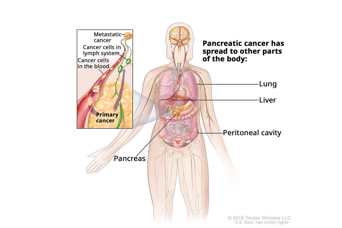 A drawing shows how pancreatic cancer may spread to other body parts. An inset shows cancer cells in the blood and lymph systems.