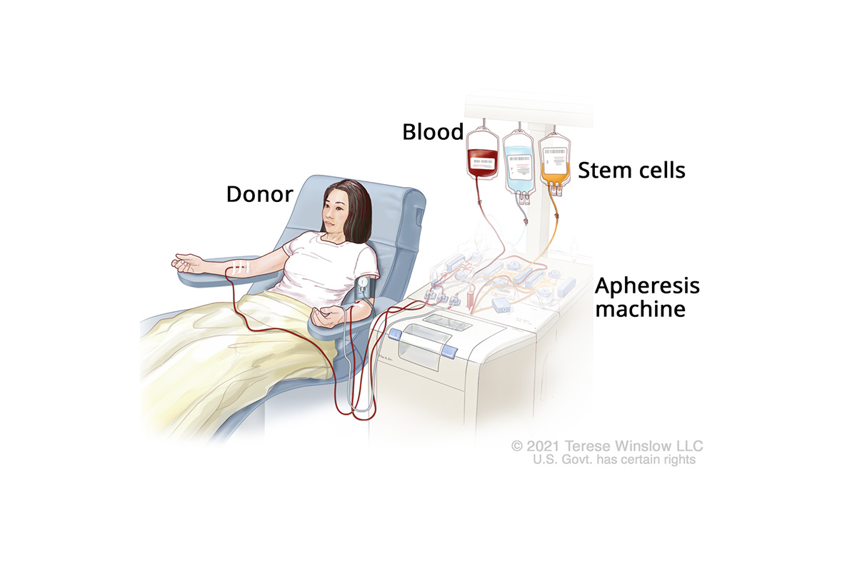 A drawing shows a donor giving blood through an apheresis machine. It separates stem cells from the blood.
