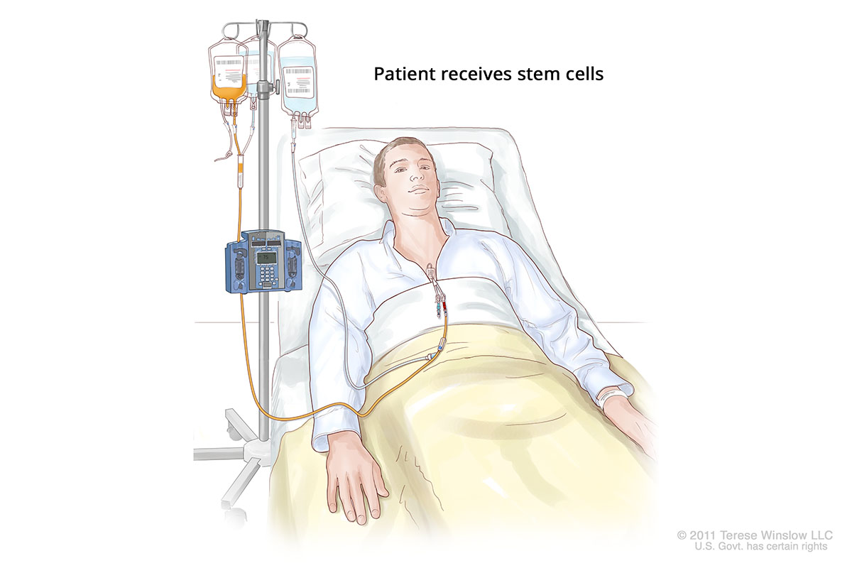 A drawing shows a patient receiving donated stem cells through an IV and chest port.