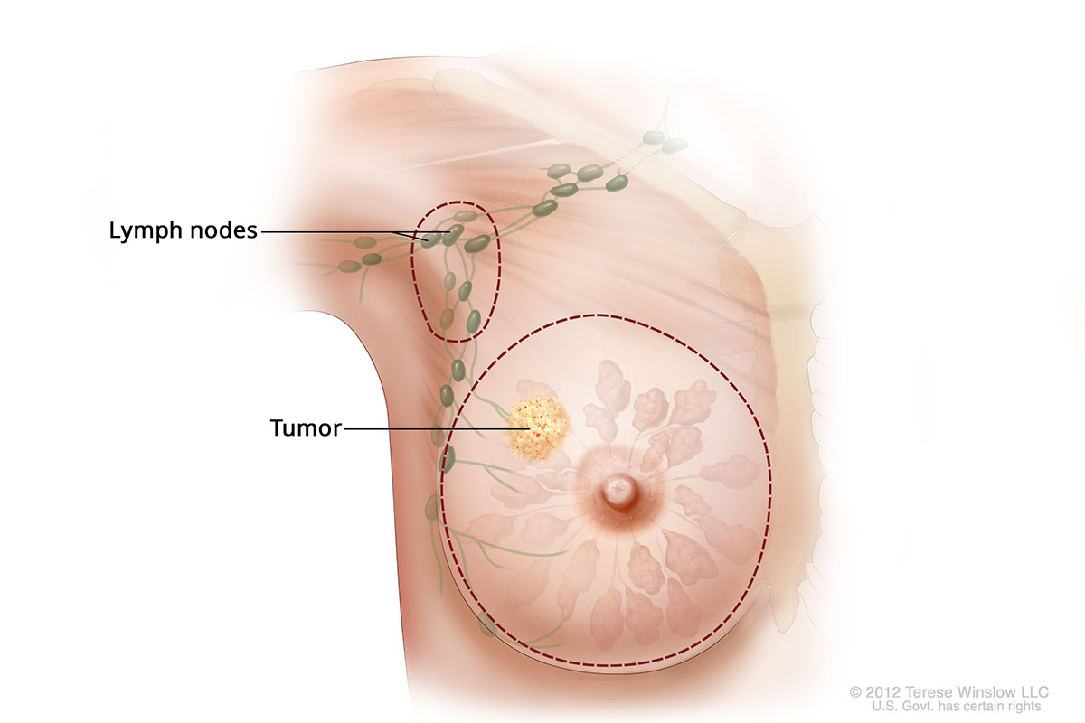 A medical illustration of a simple or total mastectomy. The breast and nearby lymph nodes are outlined.