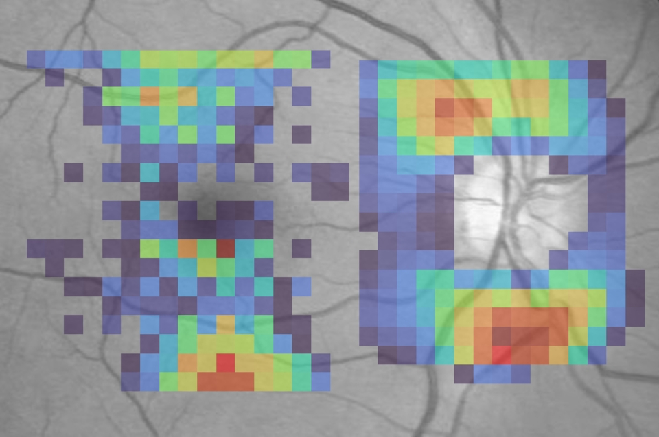 An AI “attention map” overlaid on a retinal photograph.