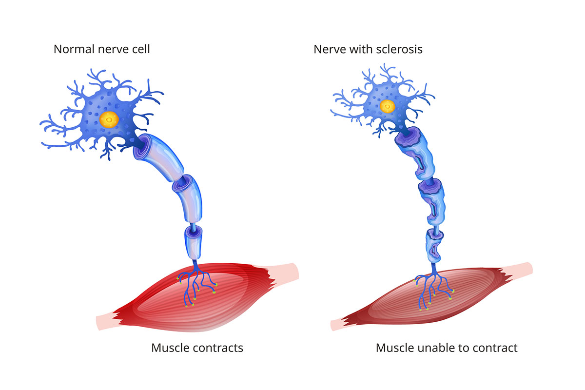 ALS diagram with nerve and muscle cell