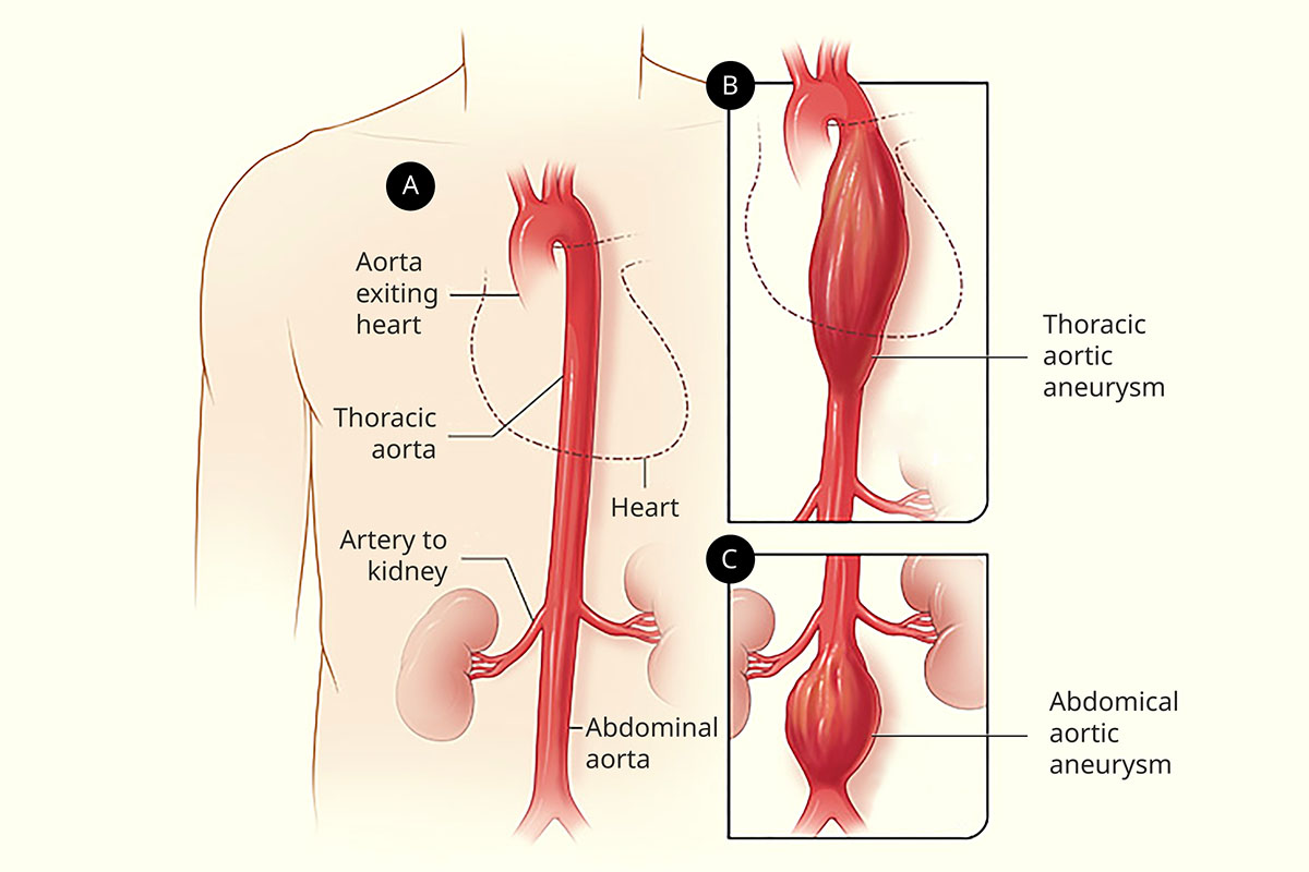 This model of a thoracic aortic aneurysm and an abdominal aortic aneurysm show how the aorta bulges.