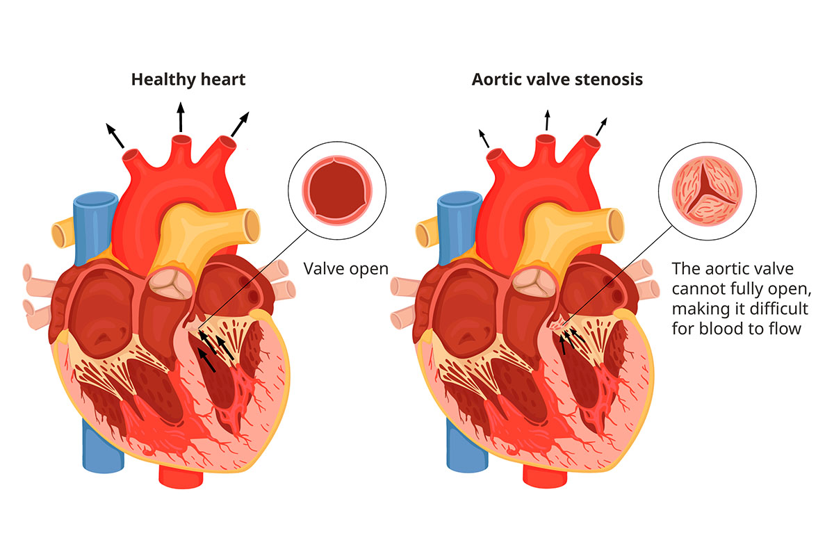 Side-by-side diagrams of a healthy heart with an open aortic valve, and a heart with a partially closed aortic valve.