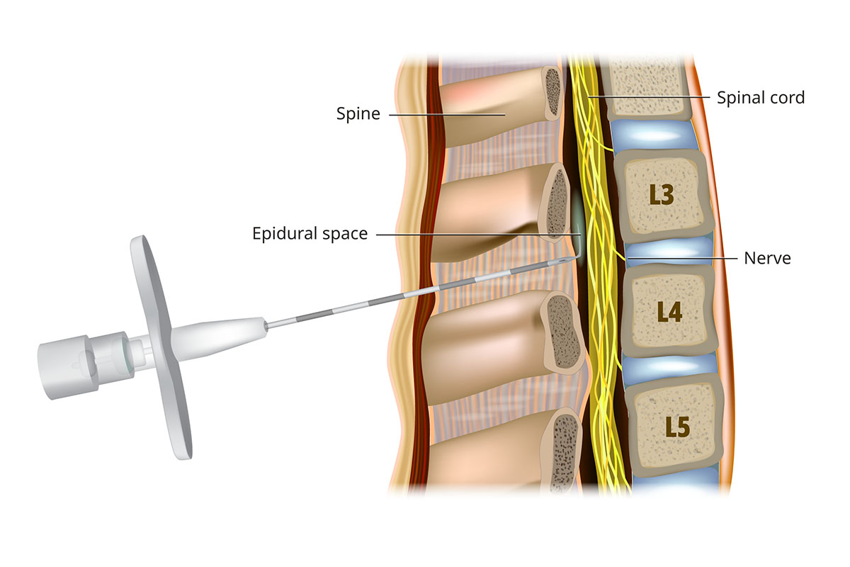 Diagram of the spine and spinal cord showing where the epidural tube enters your back and delivers medication.